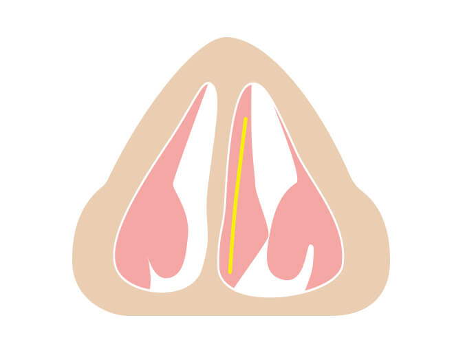 左の鼻中隔の粘膜を切開します