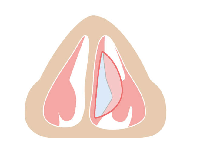 粘膜をはがし、軟骨・骨を出します