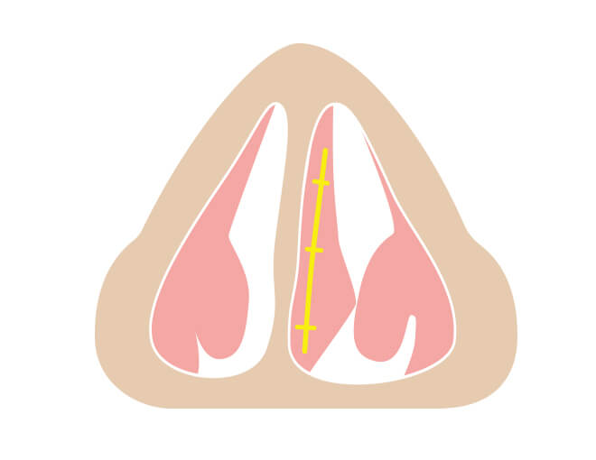 粘膜を縫合します