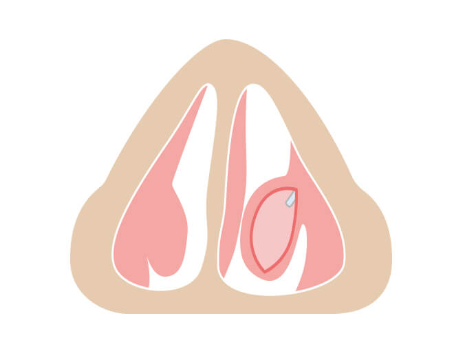 下鼻甲介の骨と神経を摘出します