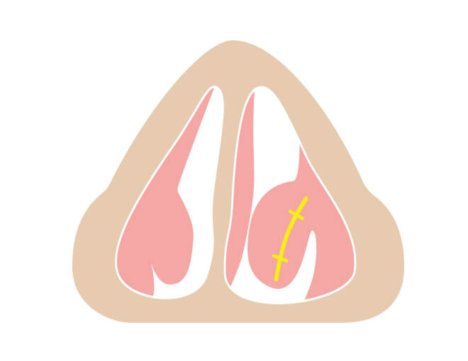 粘膜を縫合します