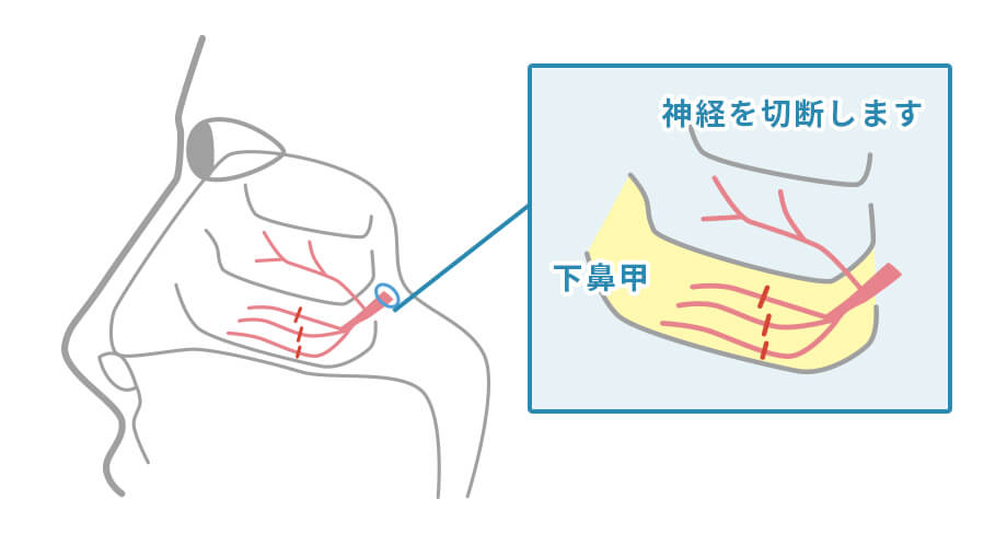 後鼻神経切断術