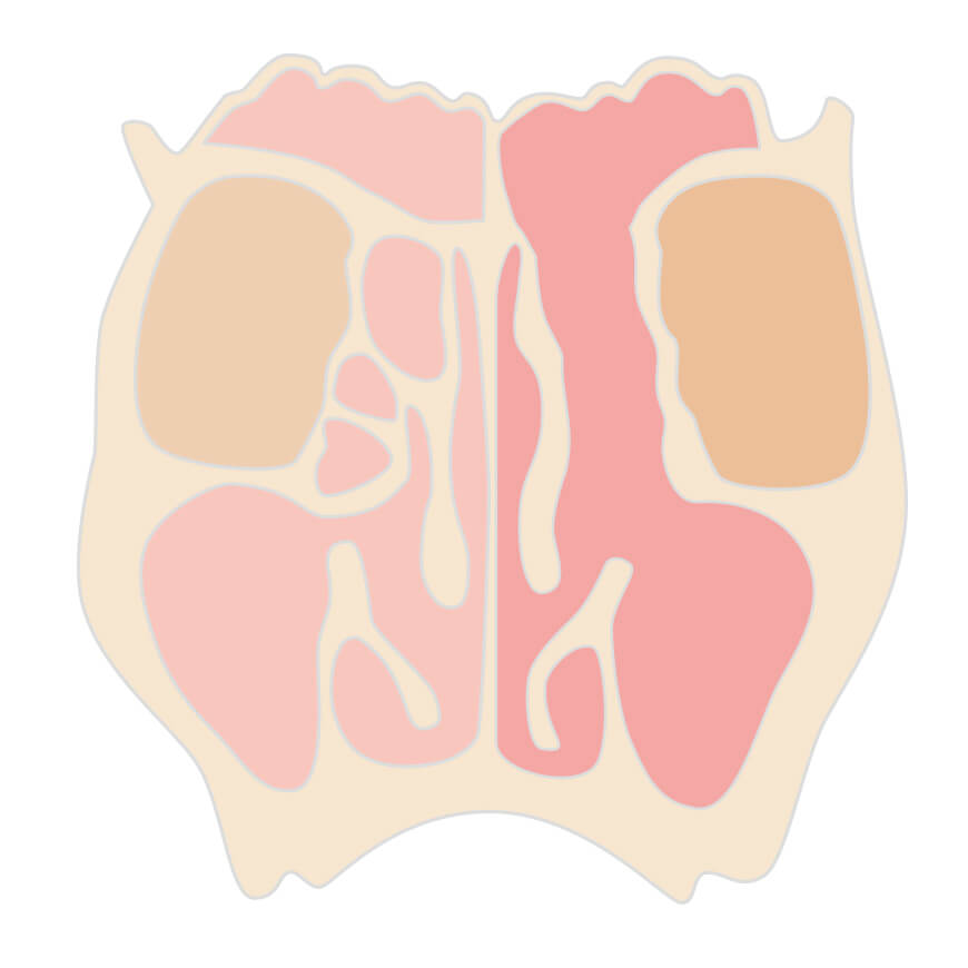 副鼻腔内視鏡手術